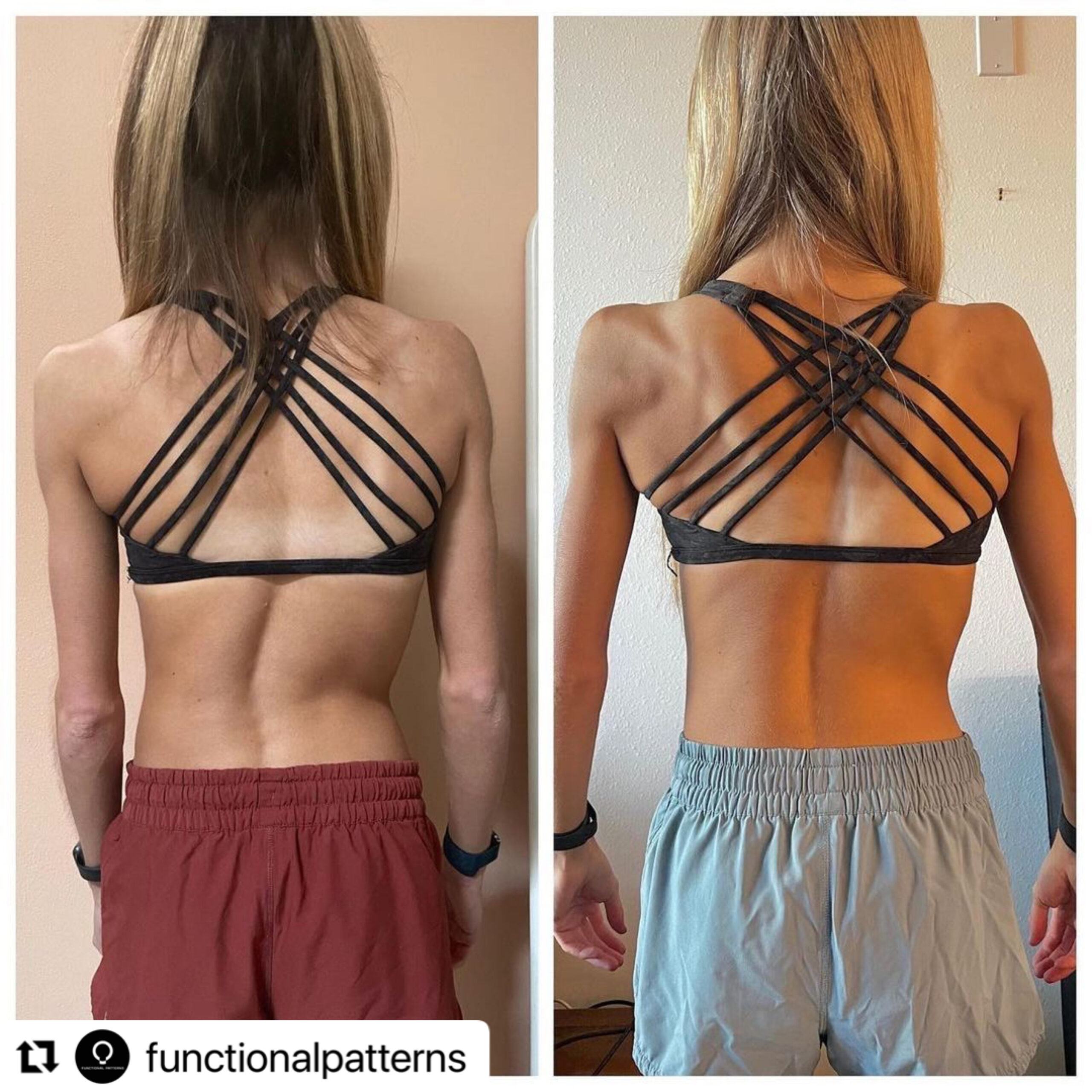 Functional Patterns Scoliosis Results